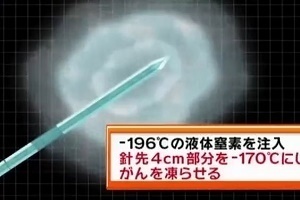 乳がん 非切除凍結治療