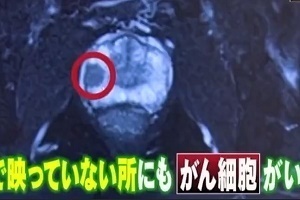 宮本亜門 がん検査