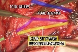 超巨大脳腫瘍 摘出手術
